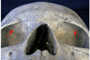 Cribra orbitalia — мелкие отверстия в стенках глазниц, признак анемии и нехватки витамина C. Фото с сайта www.ucm.es