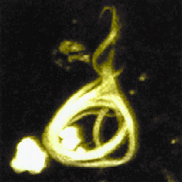 Микроскопическое изображение нейрофибриллярного клубка, образованного гиперфосфорилированным тау-белком. Изображение с сайта ru.wikipedia.org