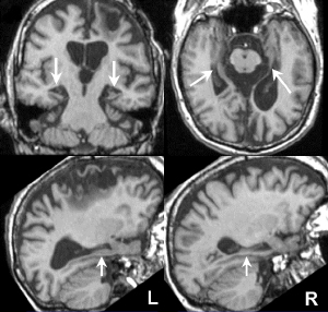 Изображения мозга K.C., полученные при помощи магнитно-резонансной томографии. Стрелкой показан дегенерировавший гиппокамп (левый и правый). Фото из дополнительных материалов к обсуждаемой статье в Science