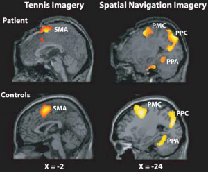 Томограммы мозга пациентки—овоща (вверху) и здоровых волонтеров (внизу). Слева — выполнение мысленного задания «играть в теннис», справа — воображаемое путешествие по комнатам дома. Фото из обсуждаемой статьи в Science
